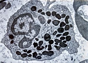 F,61y. | blood - eosinophilic granulocyte F,61y. | blood - eosinophilic granulocyte